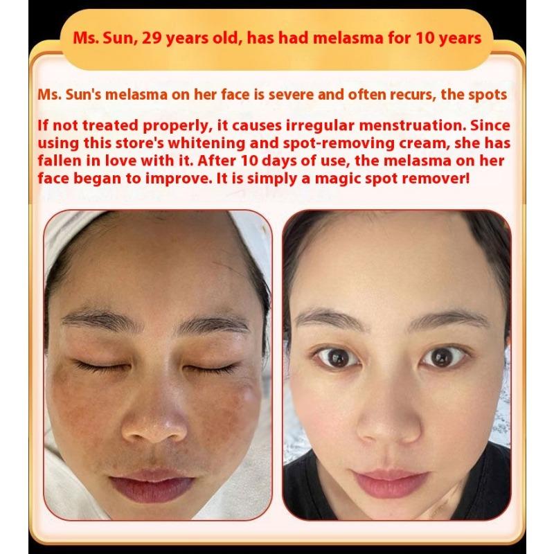 Whitening and Freckle Removing Cream Face Cream Lightening and Removing Spotles Sunburn Brightening Skin Color