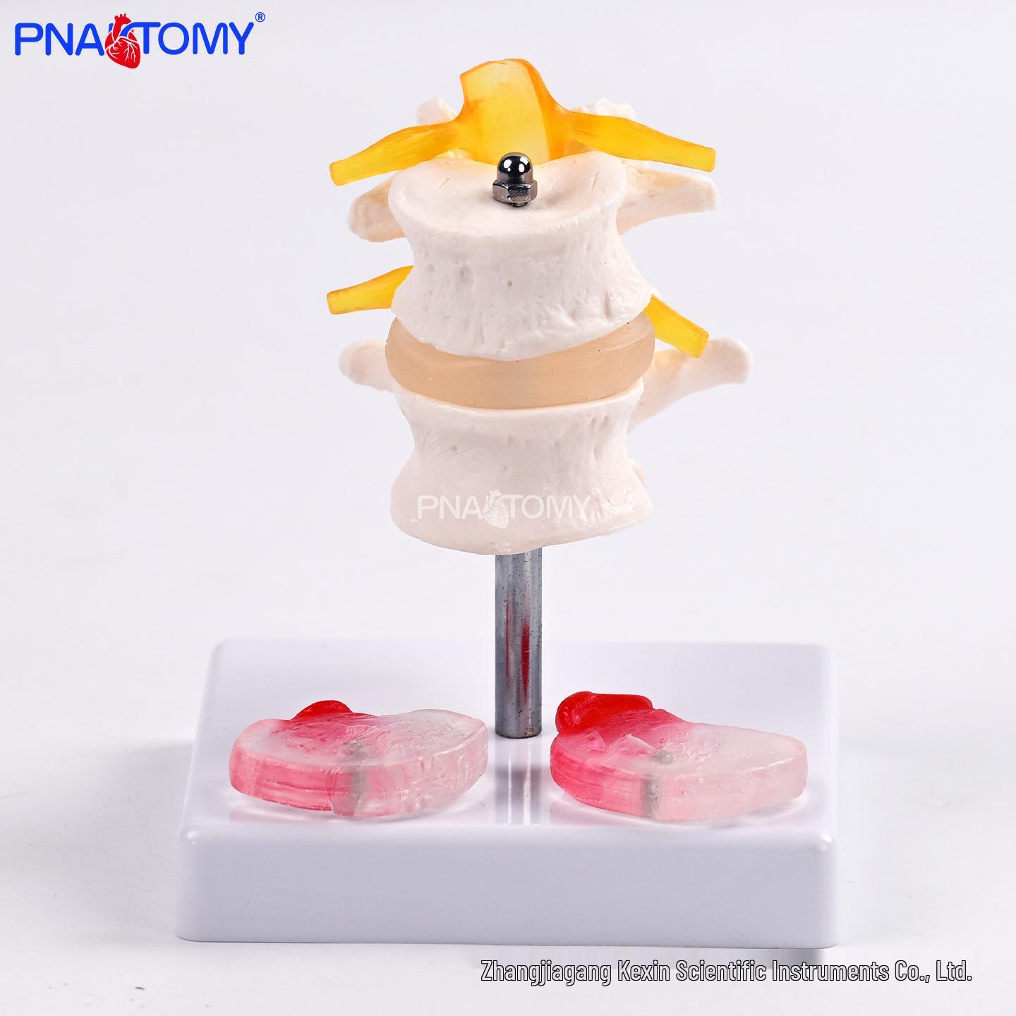 Herniated Disc Model for Lumbar & Cervical Spine Lesion Demonstration and Nerve Compression Teaching PNT-0130