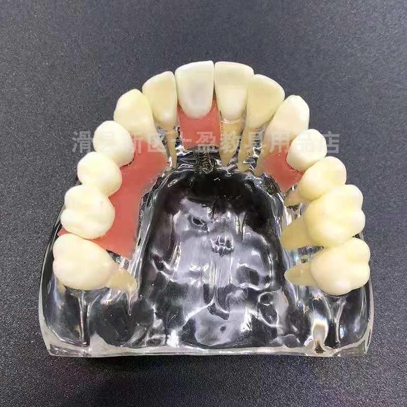 Modèle d'implant dentaire: Demi-bouche avec support, pilier, gencive molle, couronne, restauration de pont