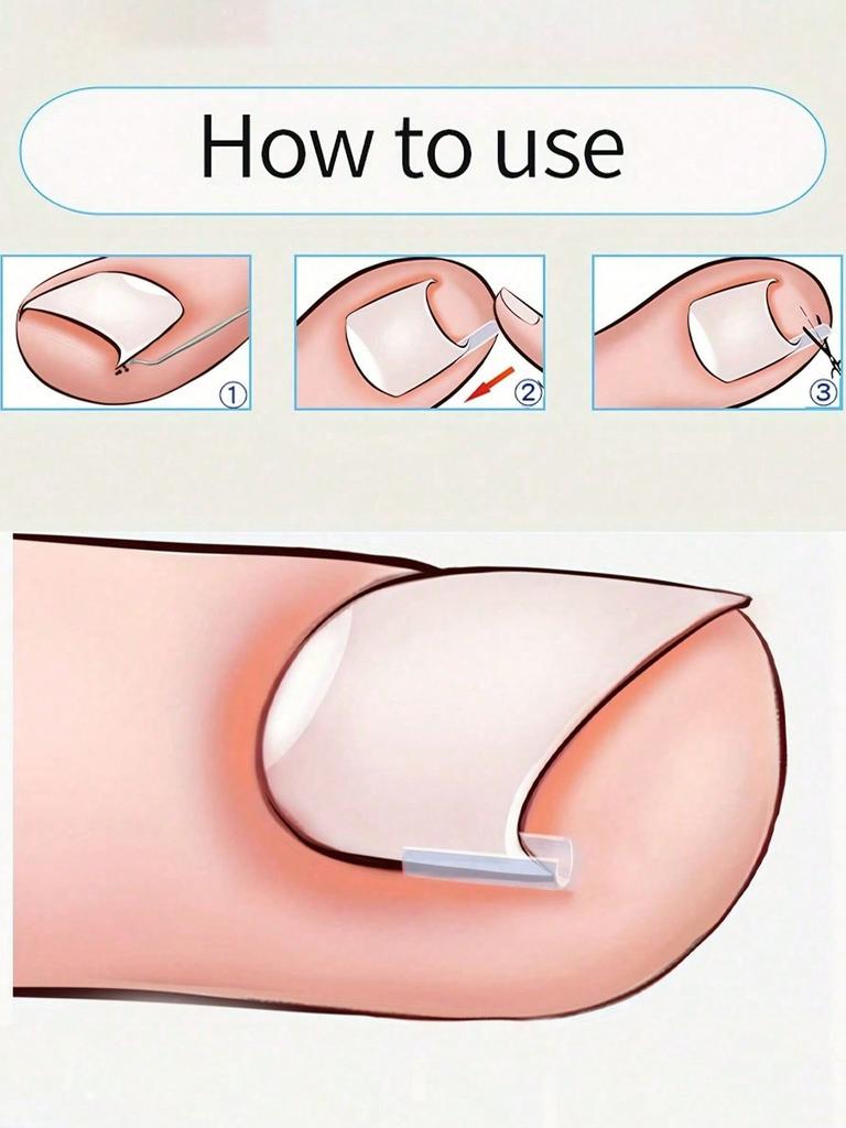 High Precision Wide Angle Nail Clippers, Professional Thick Nail Trimmer And Edge Cutter, For Ingrown Nail And Nail Groove Inflammation