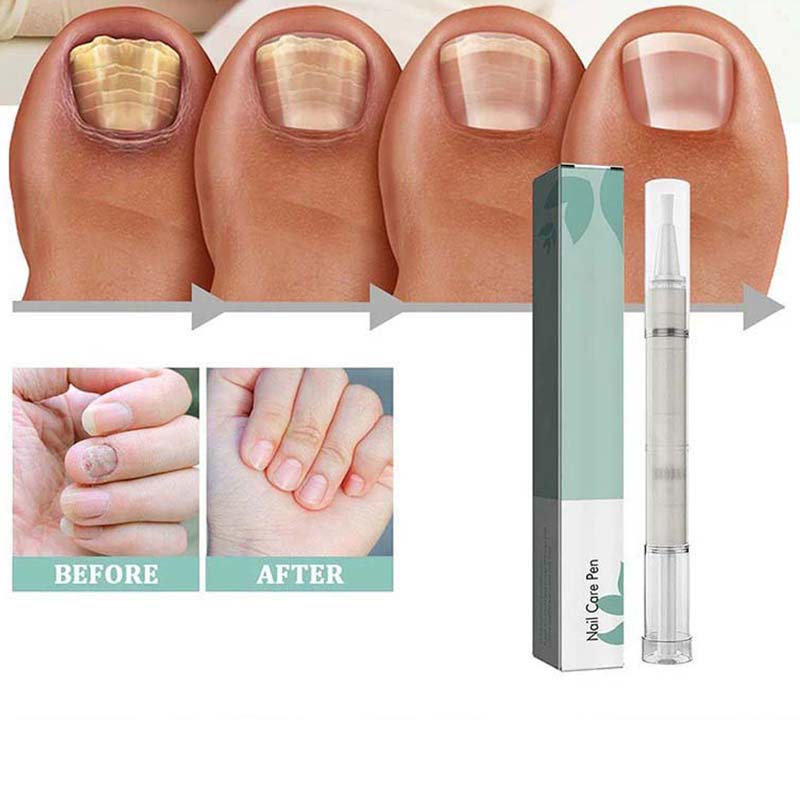4ml Nail Repair Pen Anti Nail Dry Foot Serum Moisturizing Feet Care Nail Repair Toenail Care Tool Nail  Strengthening Serum Nails Nutrition Oil