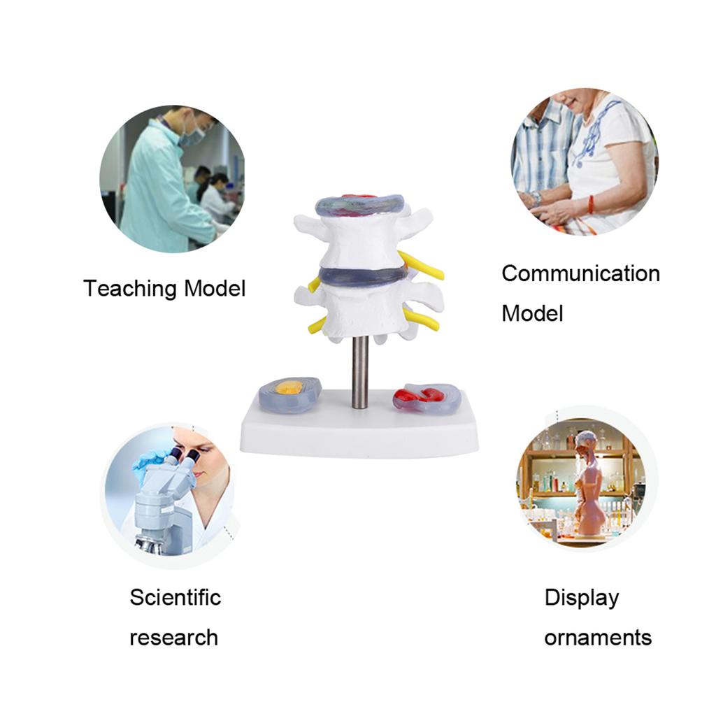 Anatomical Lumbar Disc Herniation Demonstration Model Human Spine School Training Supplies