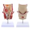 Modèle Anatomique Humain Modèle de Rectum Humain Modèle des Pathologies du Rectum Humain Support Pédagogique pour l'Éducation Scientifique