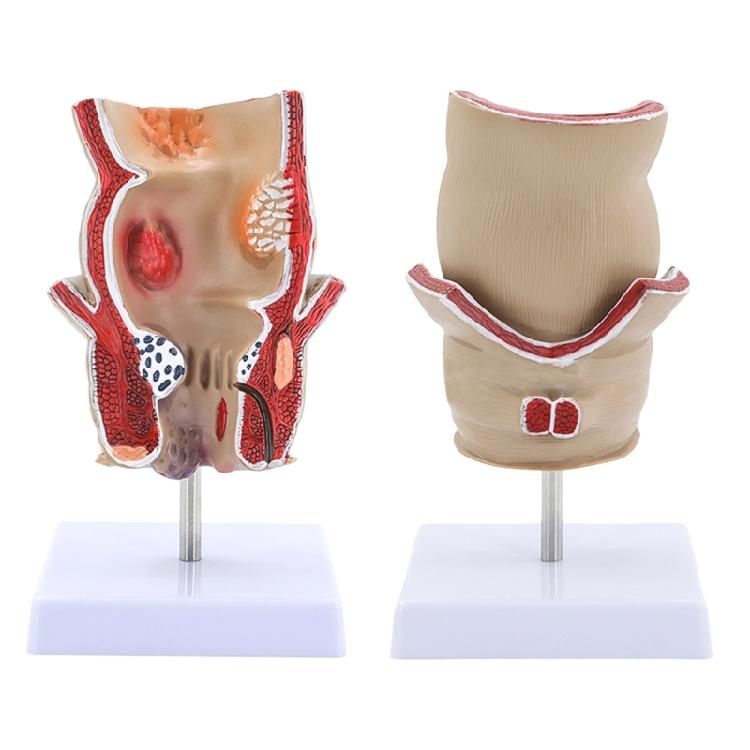 Modèle Anatomique Humain Modèle de Rectum Humain Modèle des Pathologies du Rectum Humain Support Pédagogique pour l'Éducation Scientifique