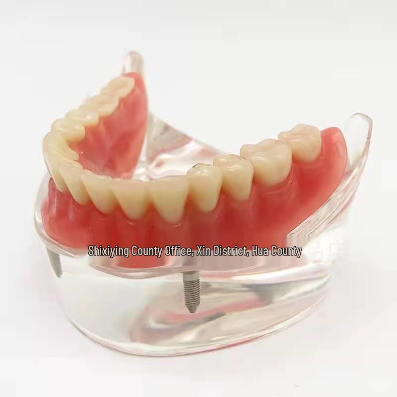Modelo Dental de Media Mandíbula con Demostración de Implante Dental y Restauración de Dentadura Postiza