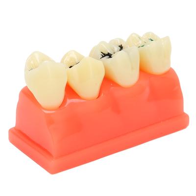 Dental Caries Model Resin 4 Teeth Oral Care Educational Decayed Tooth Display Model for Dental