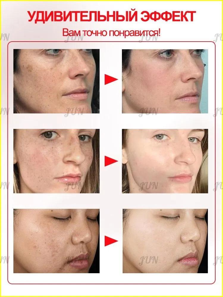 Retiderm anti-aging face cream, Freckle removal and whitening cream is able to remove freckles, chloasma, sunspots, age spots, Contains hyaluroni