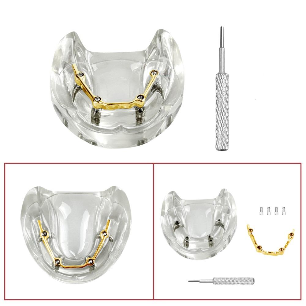 Dental Teeth Model With Implants Gold/Silver Bar Type Overdenture Restoration Treatment Typodont For Dentist Patient Teaching
