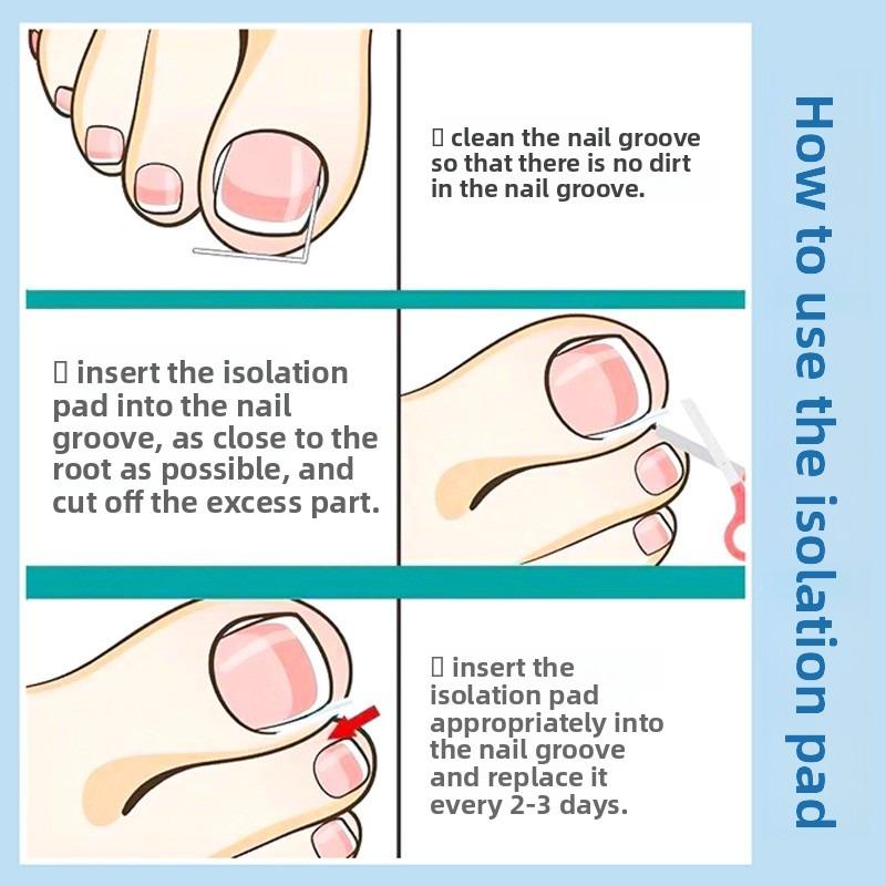 Palm Groove Nail Improvement Device for Ingrown Toenail, Foot Nail Prevention From Growing Into The Flesh, Proper Nail Correction Tool