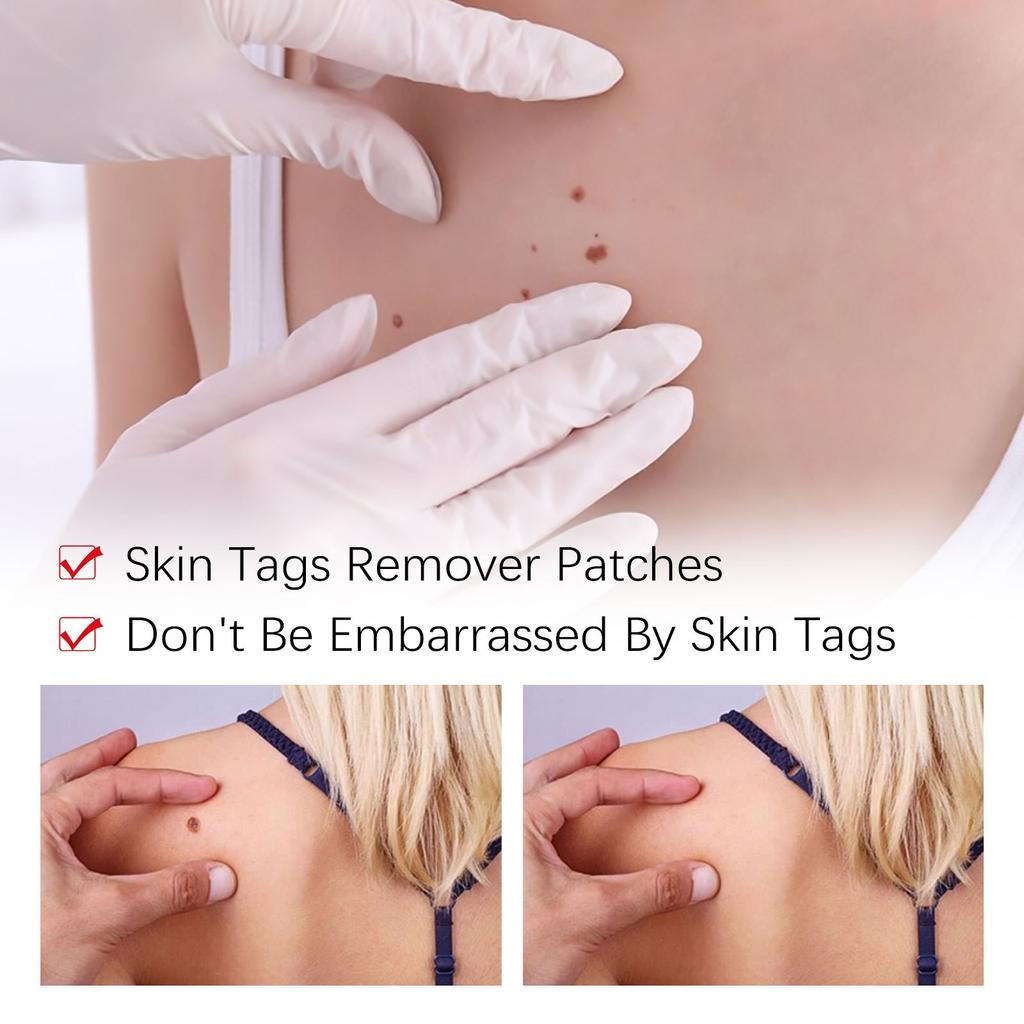 Tags & Moles Remover, WipeOff Tags & Moles Remover, WipeOff Remover 3ML