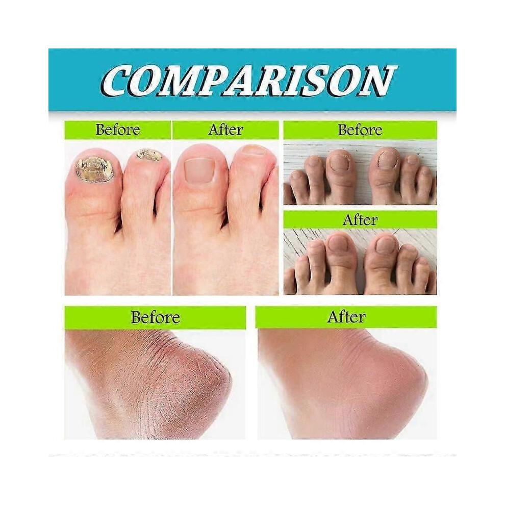 3Pcs Foot And Nail Spary, Natural And Powerful Foot Care-KAKA
