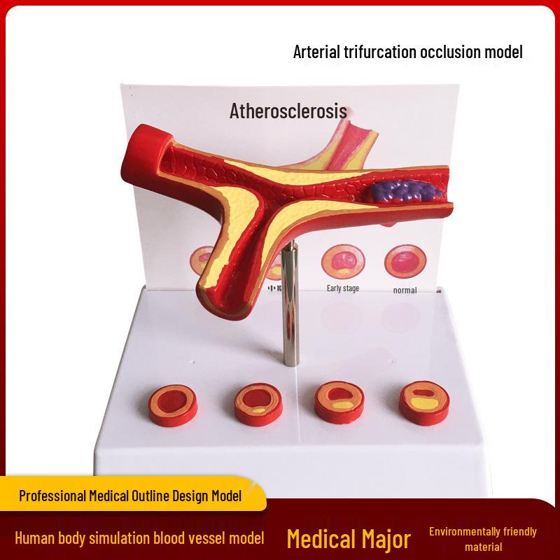 Coronary Artery Atherosclerosis & Thrombosis Human Pathology Model