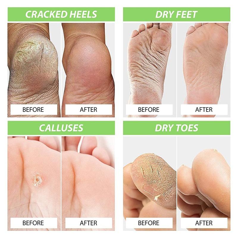 Foot Cure All-Natural Plant Foot Balm – Fuktighetsgivende fotpleiekrem for tørr hud