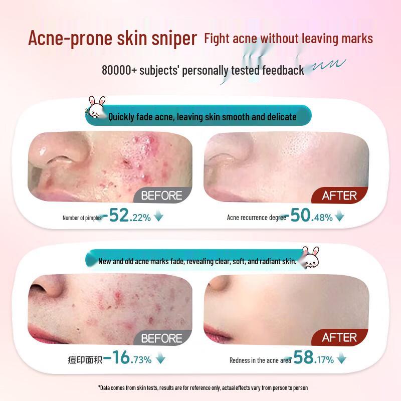 FIVERAMS Teen Acne Treatment Cream 30g