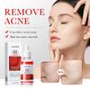 Acne Serum SADOER Fruit Acid Dilutes Acne Marks, Hydrates and Moisturizes