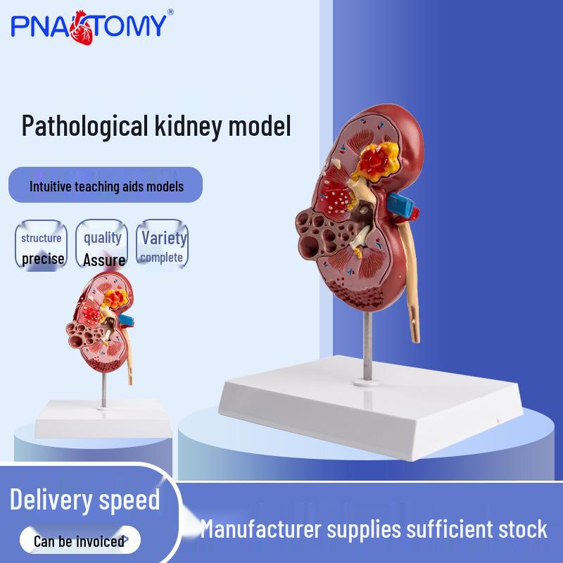 Life-Size Pathological Kidney and Adrenal Gland Model for Human Anatomy 18x14x17 cm