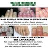 Jaysuing 7 Days Nail Fungus Treatment, Fast-Acting Nail Repair Serum with Ginger Formula, Promotes Healthy Nail Growth