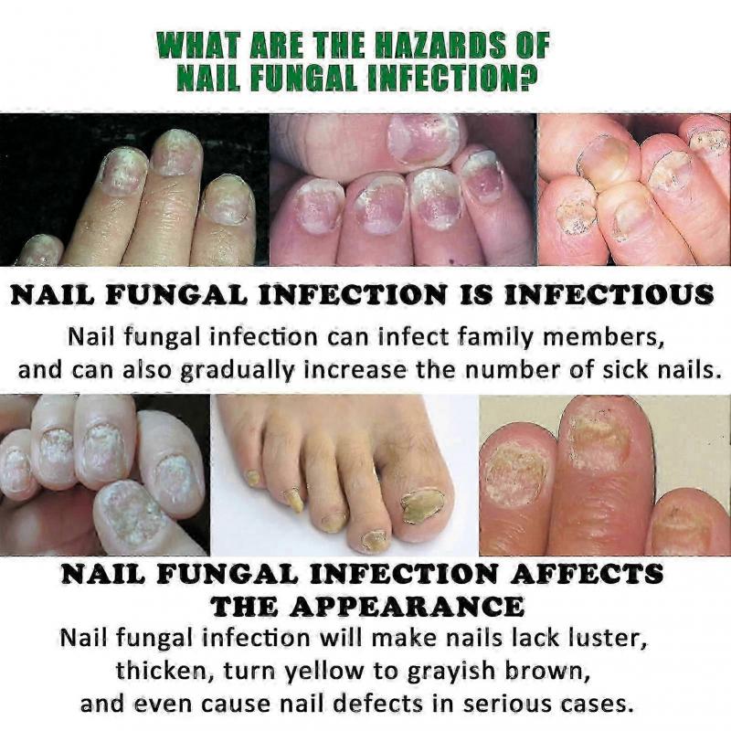 Jaysuing 7 Days Nail Fungus Treatment, Fast-Acting Nail Repair Serum with Ginger Formula, Promotes Healthy Nail Growth