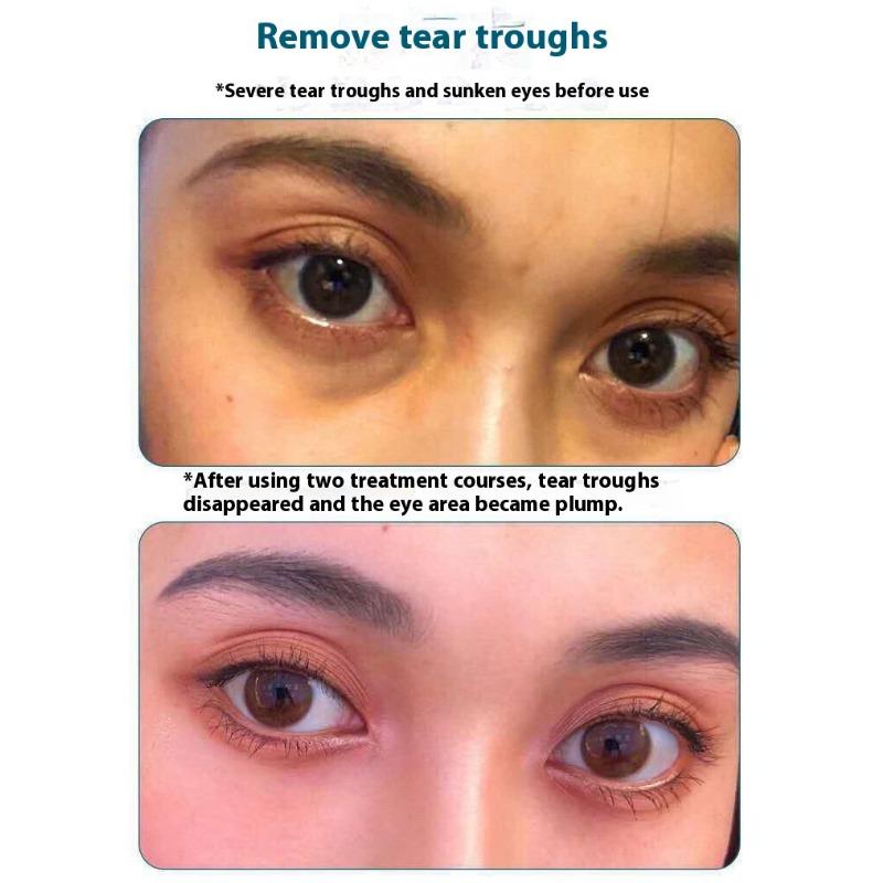 Fengying Elasmizing Essence Fills Apple Muscle Fengface Essence Huafeng Forehead Tear Groove Lifting