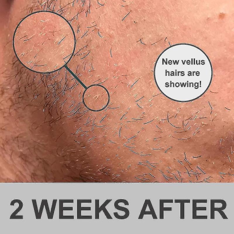 Beard Growth Kit, Beard Derma Roller 0.3mm, Beard Oil For Facial Hair Growth For Men And Dads, Grooming Tool - Shenxin