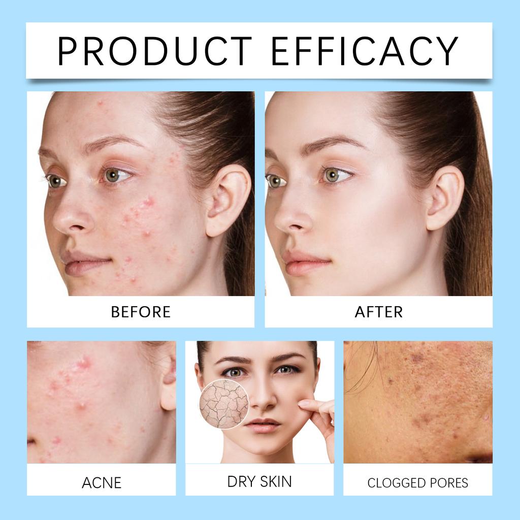 Azelaic Anti-acne Cream Soothes Acne, Purifies And Moisturizes The Skin, Improves Skin Texture, And Acne Cream