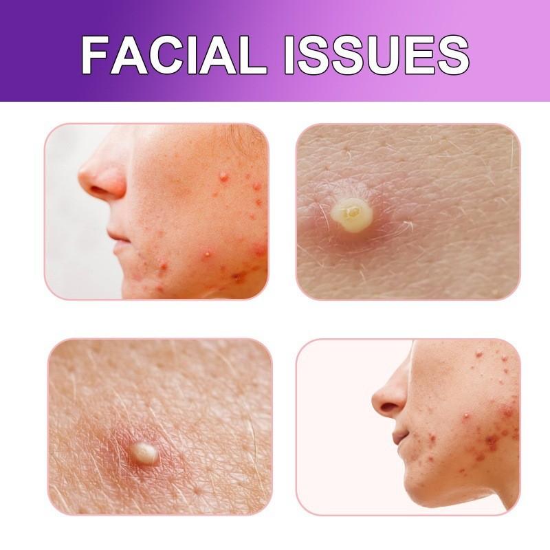 Jaysuing Acne Patches For Diminishing Facial Acne And Blemishes With Pore Care 180 Pcs