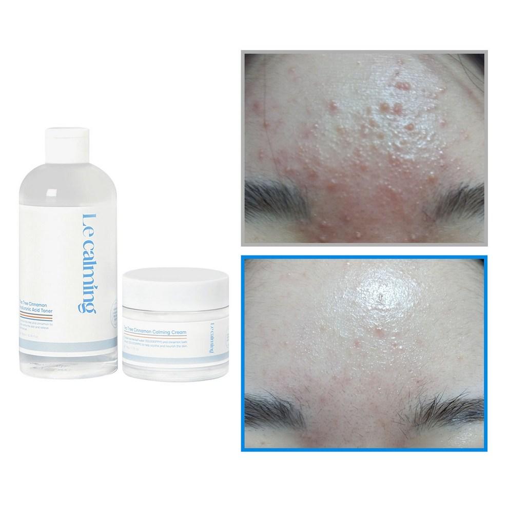 

[Le calming] 2-item Trouble Care Set: Tea Tree & Cinnamon Hyaluronic Acid Toner & Cream - Acne Relief, Pore Care & Deep Hydration for Sensitive Skin
