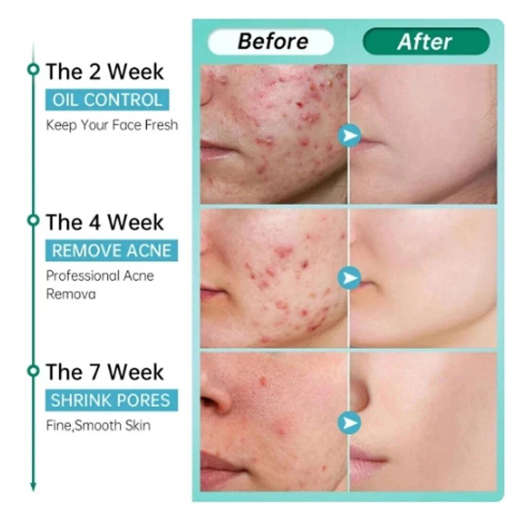 Salicylic Acid Acne Cream For Face Against Black Dots Acne Treatment & Open Pores Moisturizing Skin Care Cream - 50 g