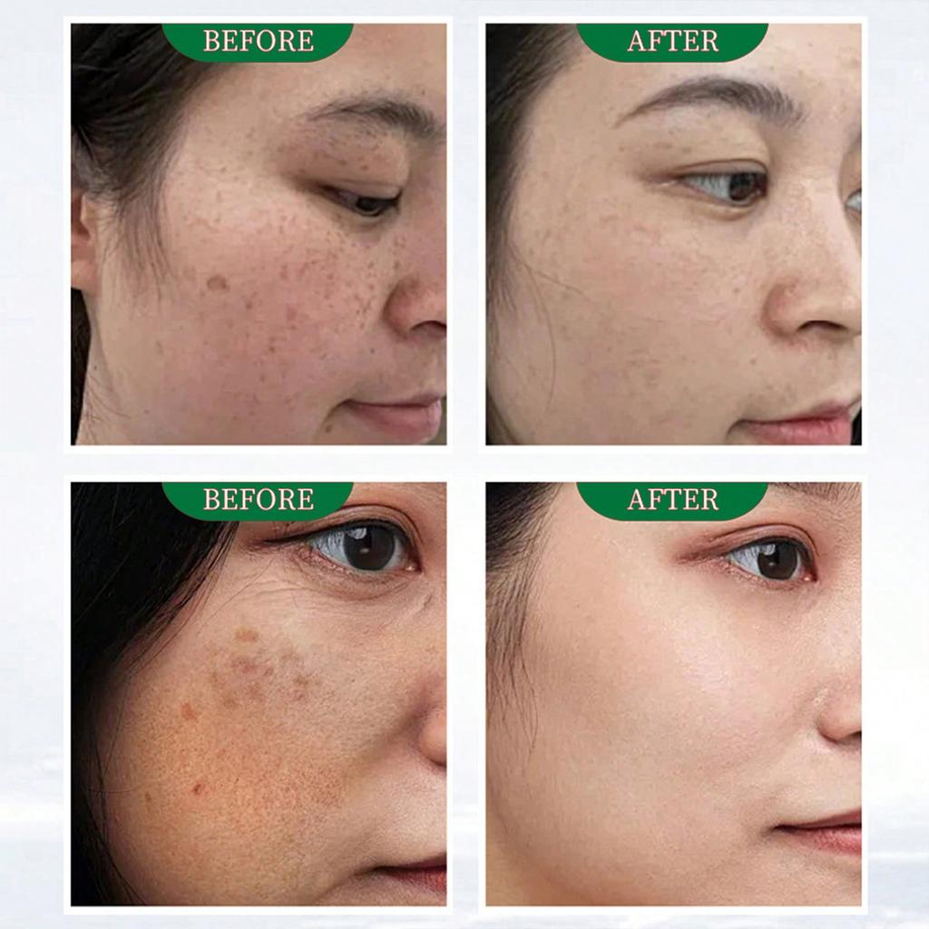Dunkle Flecken Korrektur Aufhellendes Serum Für Strahlende Haut Gleichmäßiger Teint Aufhellen Hyperpigmentierung
