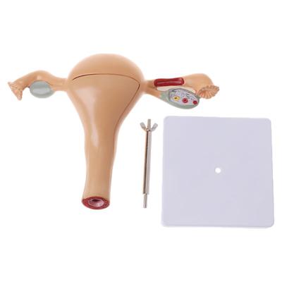 Human Pathological Uterus Ovary Model Anatomical Anatomy Disease Pathology Medical Lesion Teaching