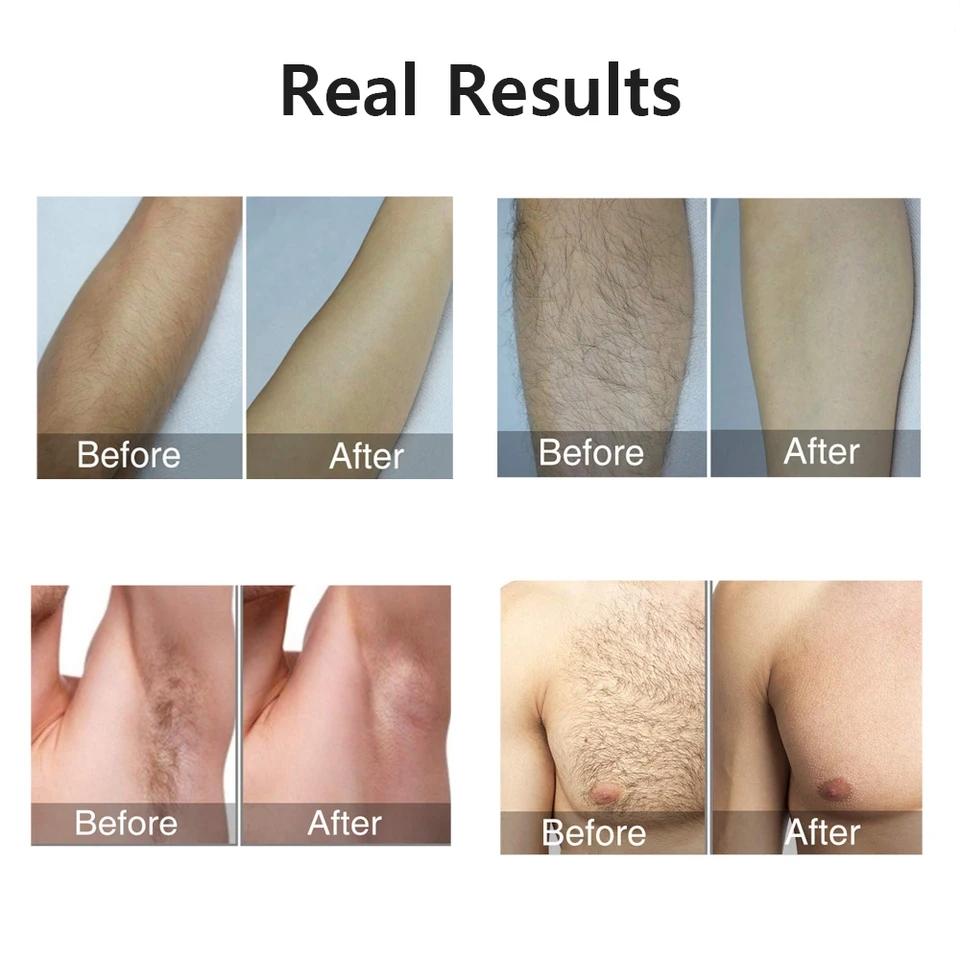 HOMZY Portable IPL Laser Epilator 999999 Flashes - Painless, Permanent Hair Removal for Women’s Body and Bikini Line