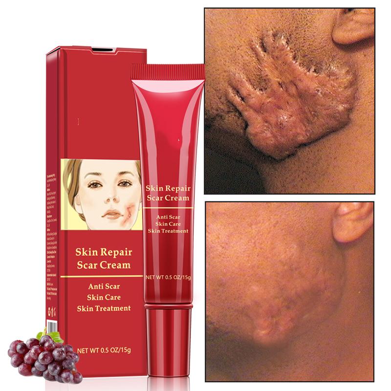 Scar Removal Cream for All Skin Types - Reduces Scars, Acne Marks, and Stretch Marks