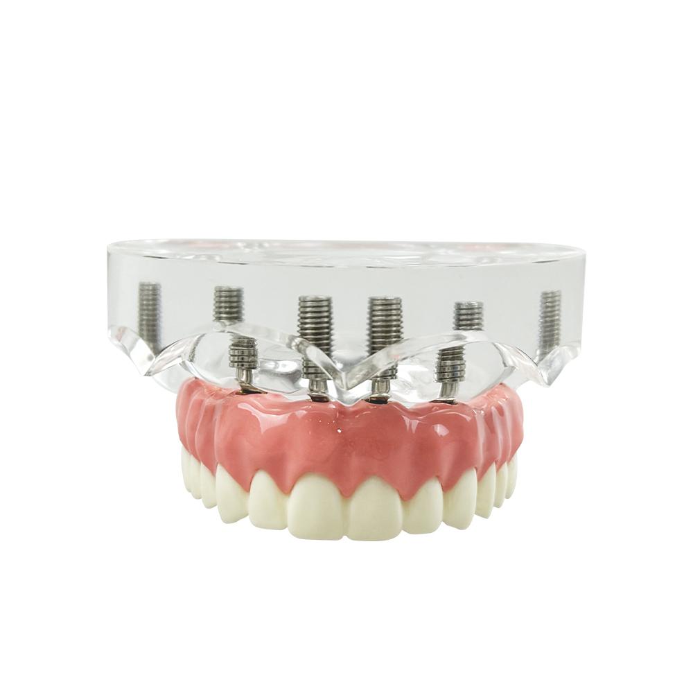Dental Implant Model With 6 Implants