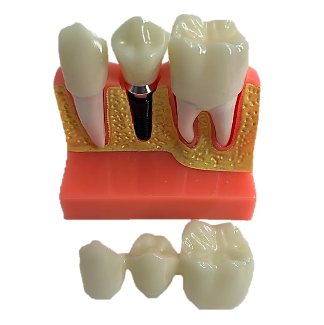 

ST TS Модель зубного имплантата, Анатомическая модель зуба, Съемная, для стоматологической демонстрации