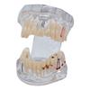 Transparent Teeth Model - Removable Adult Tooth Study Model, Typodont Pathological Disease Implant Teaching Tools