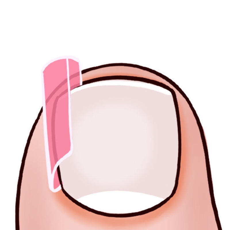 50PCS Ingrown Toenail Corrector Pads Kit Toenail Orthosis Corrector Strips Brace for Women Men