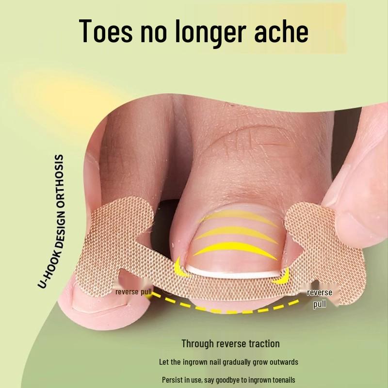 Glue-Free Natural Ingrown Toenail Corrector Stickers