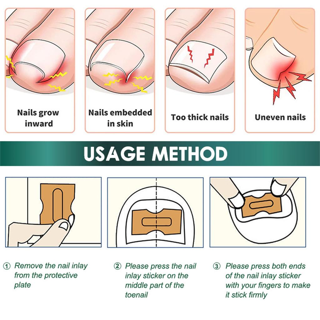 Ingrown Toenail Correction Stickers Hands And Feet Soft Nail Inlaid Nail Thickening Bright Nail Furrow Gray Nail Care Patch 50pcs