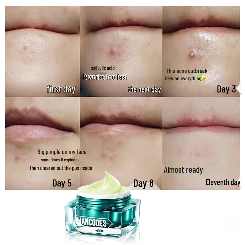 Salicylic Acid Acne Cream