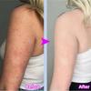 Body Whitening Cream Keratosis Pilaris Treatment Bumpy Rough Chicken Follicle Skin Repair Strawberry Legs Removal Dry Skin Care