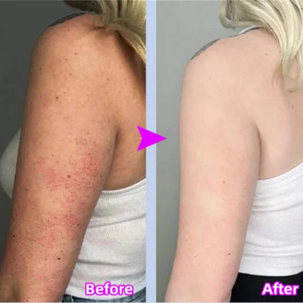 Body Whitening Cream Keratosis Pilaris Treatment Bumpy Rough Chicken Follicle Skin Repair Strawberry Legs Removal Dry Skin Care