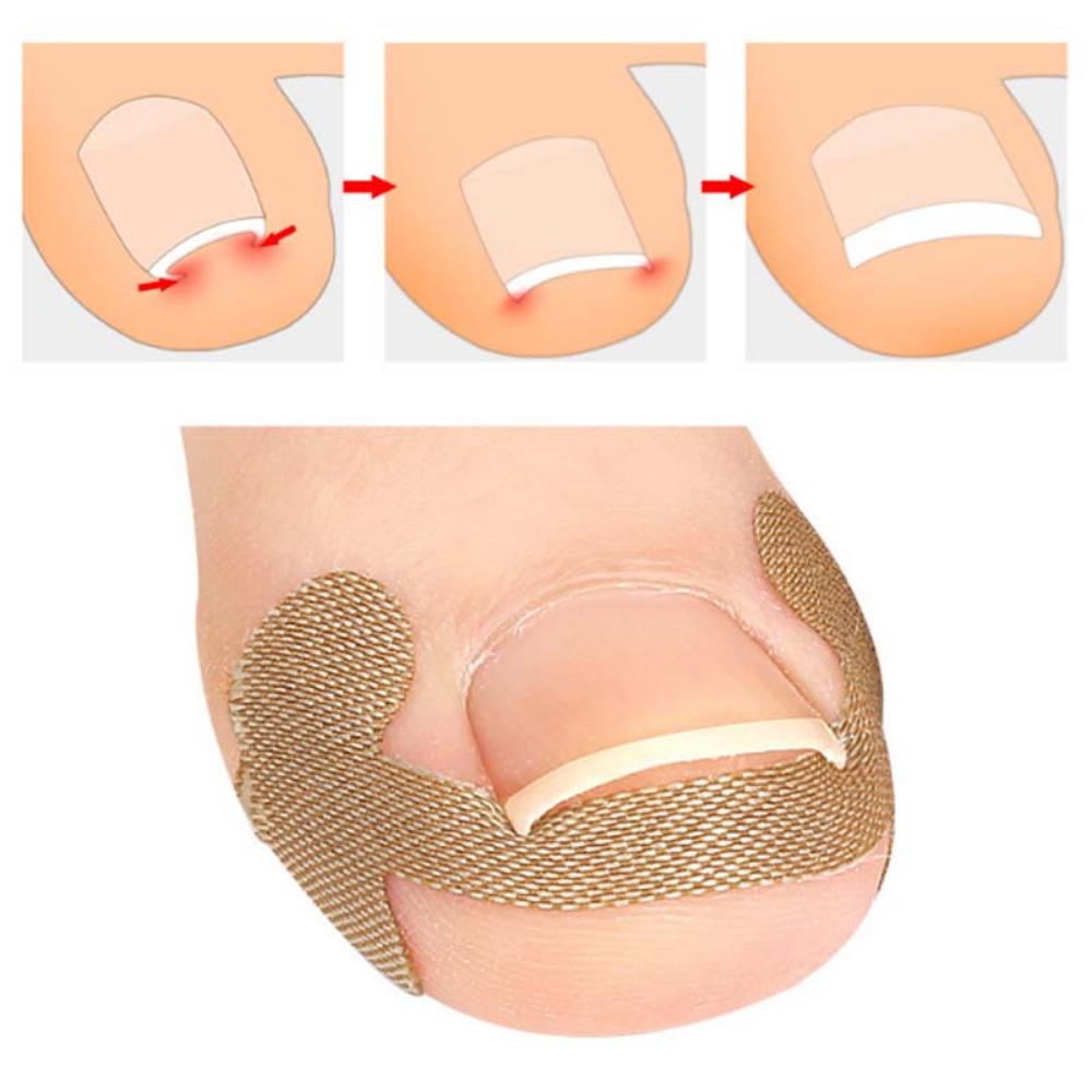 Zehennagelkorrektur für Pflege Zehennagelbehandlung Aufkleber Korrektur Erholungspflaster Fußeinlagen