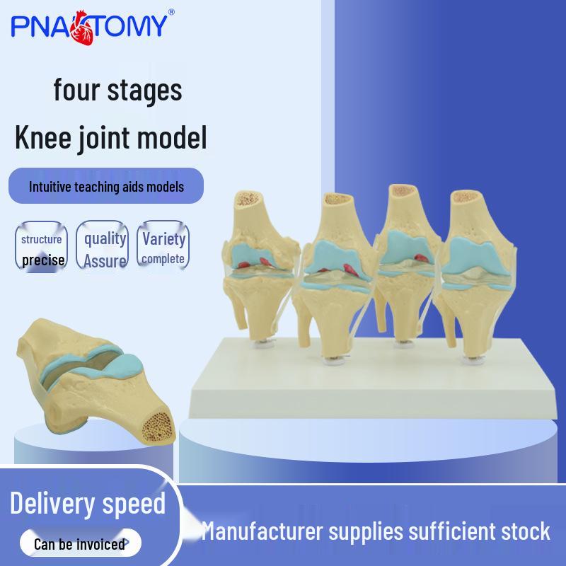 Human Knee Joint Model: Normal vs. Pathological, Medical Teaching Aid and Doctor-Patient Communication Tool PNT-0141
