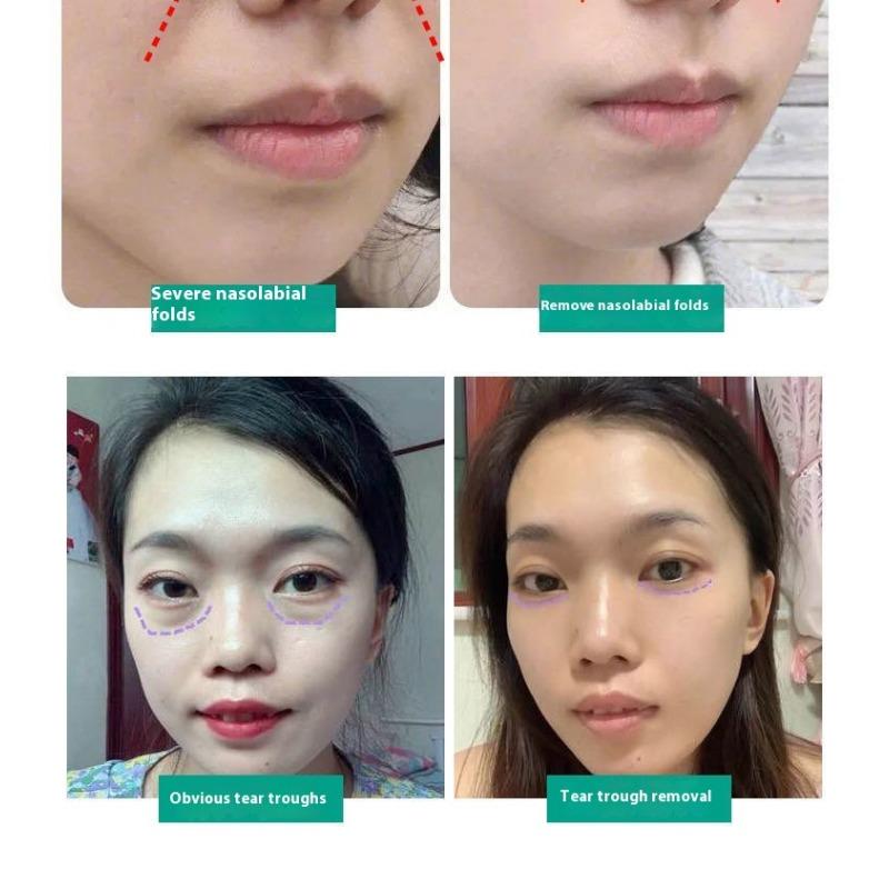 Fengying Elasmizing Essence Fills Apple Muscle Fengface Essence Huafeng Forehead Tear Groove Lifting