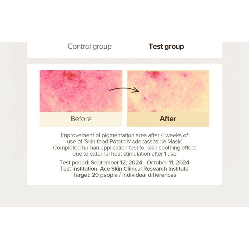 SKINFOOD - Potato Madecassoside Mask Bundle Set