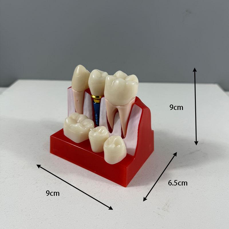 Прозора Знімна Повна Модель Щелепи з М'якими Яснами та Зубами для Підготовки до Імплантації