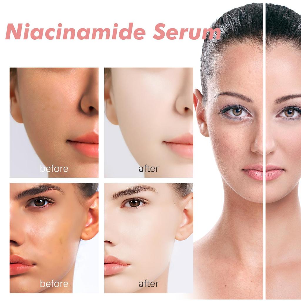 Hoygi Niacinamide Serum Firming & Hydrating Pores Fades Acne Marks & Fine Lines Brightens Skin & Reduces Dark Spots 30ml