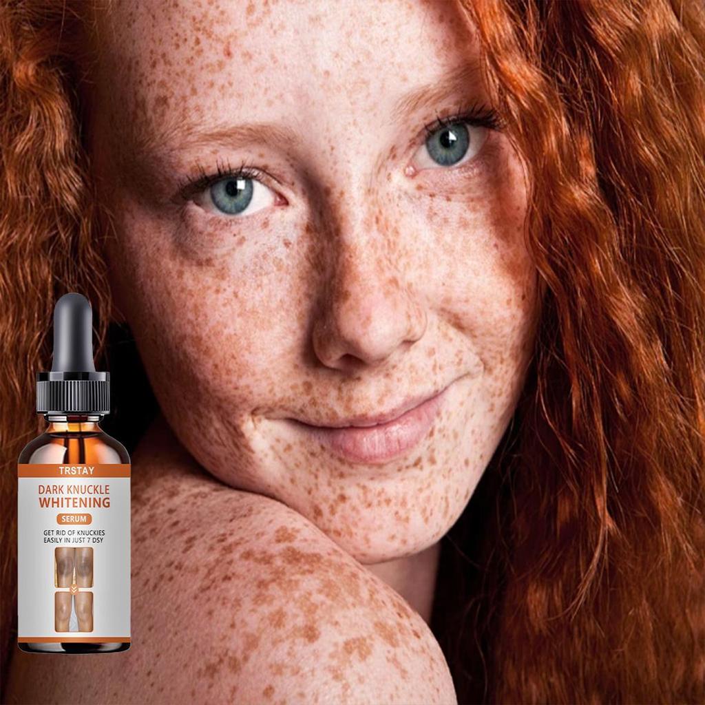 Whitening Freckles Cream Remove Melasma Dark Spot Lightening Melanin Brightening Melasma Remover Moisturize Anti-aging Face Care