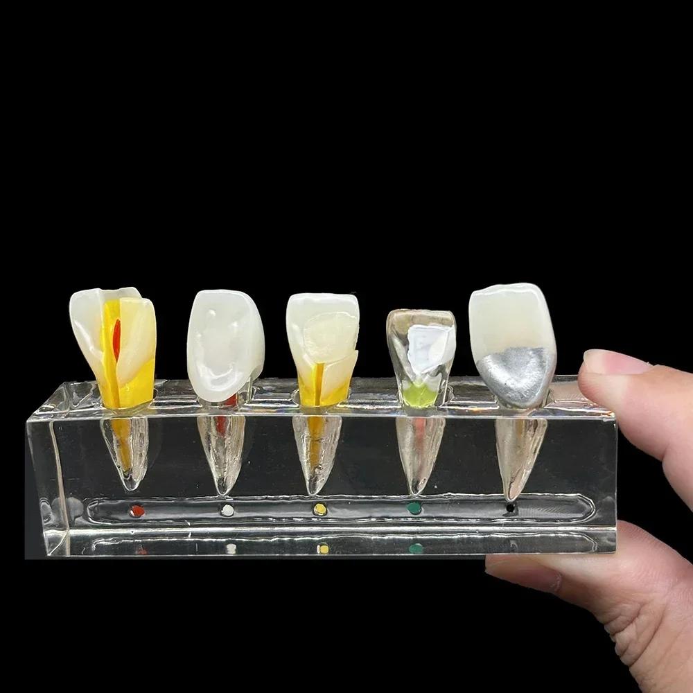Dental Pulp Restoration Pathological Model Detachable Teeth Dissecting Premolar Teeth Cavity Filling Dentist Material