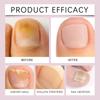 Nail Growth Serum Care Fungal Nail Pen For Restores The Healthy Appearance Of Nails Discolored Or Damaged By Fungus Nail (2ml)